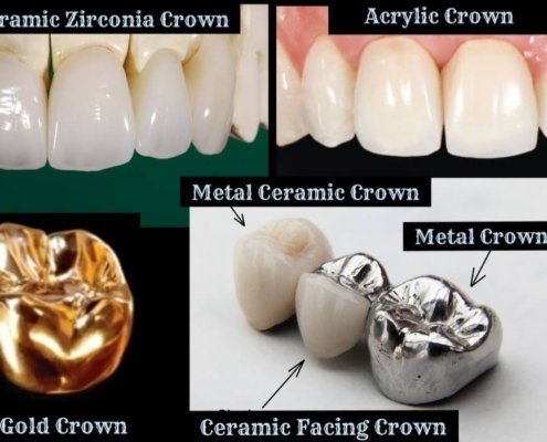 cost of crowns in india